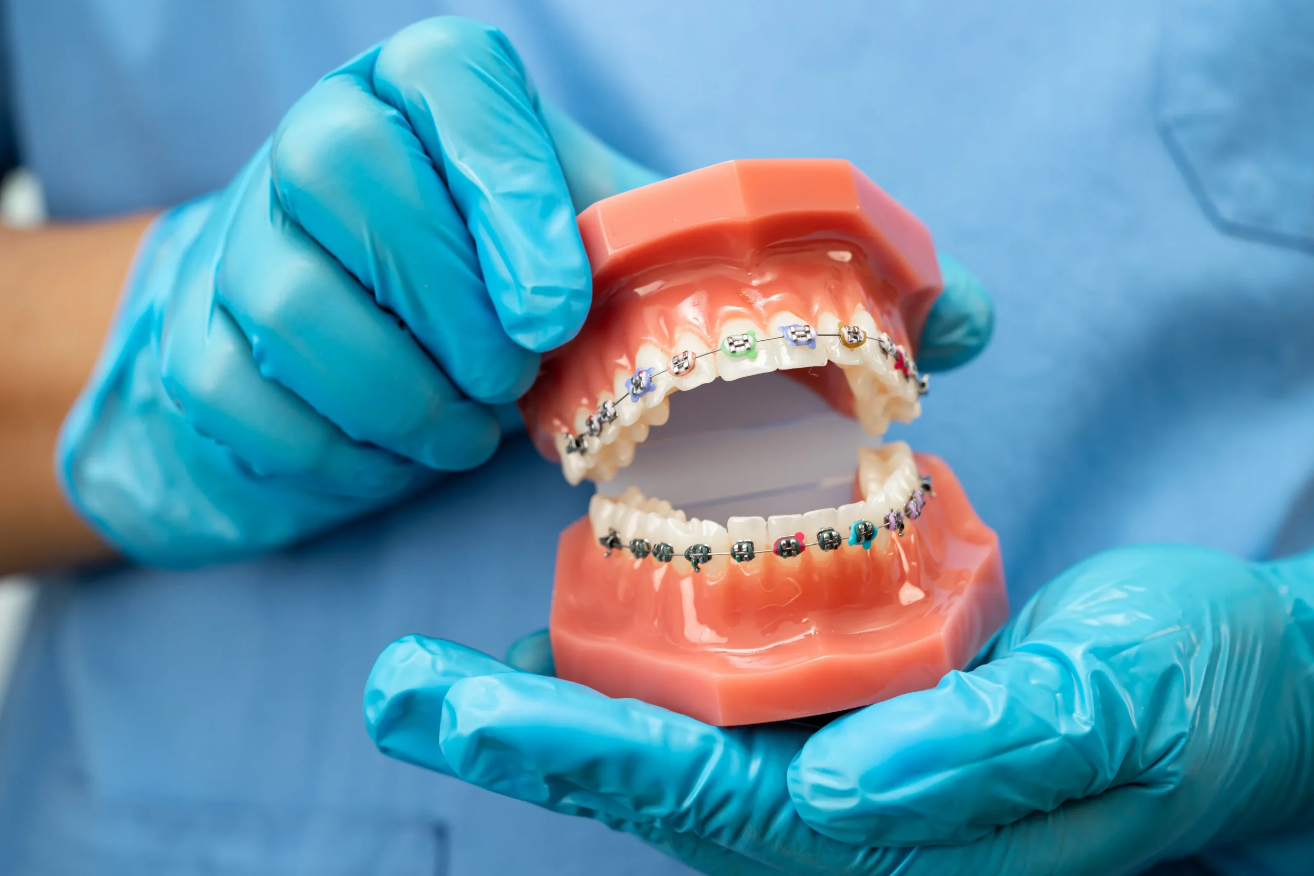 Manos de un especialista con guantes quirúrgicos azules sosteniendo un modelo tipodonto de resina con brackets metálicos y gomas de colores para explicar tratamientos de ortodoncia en la clínica Dentelier en Alicante.