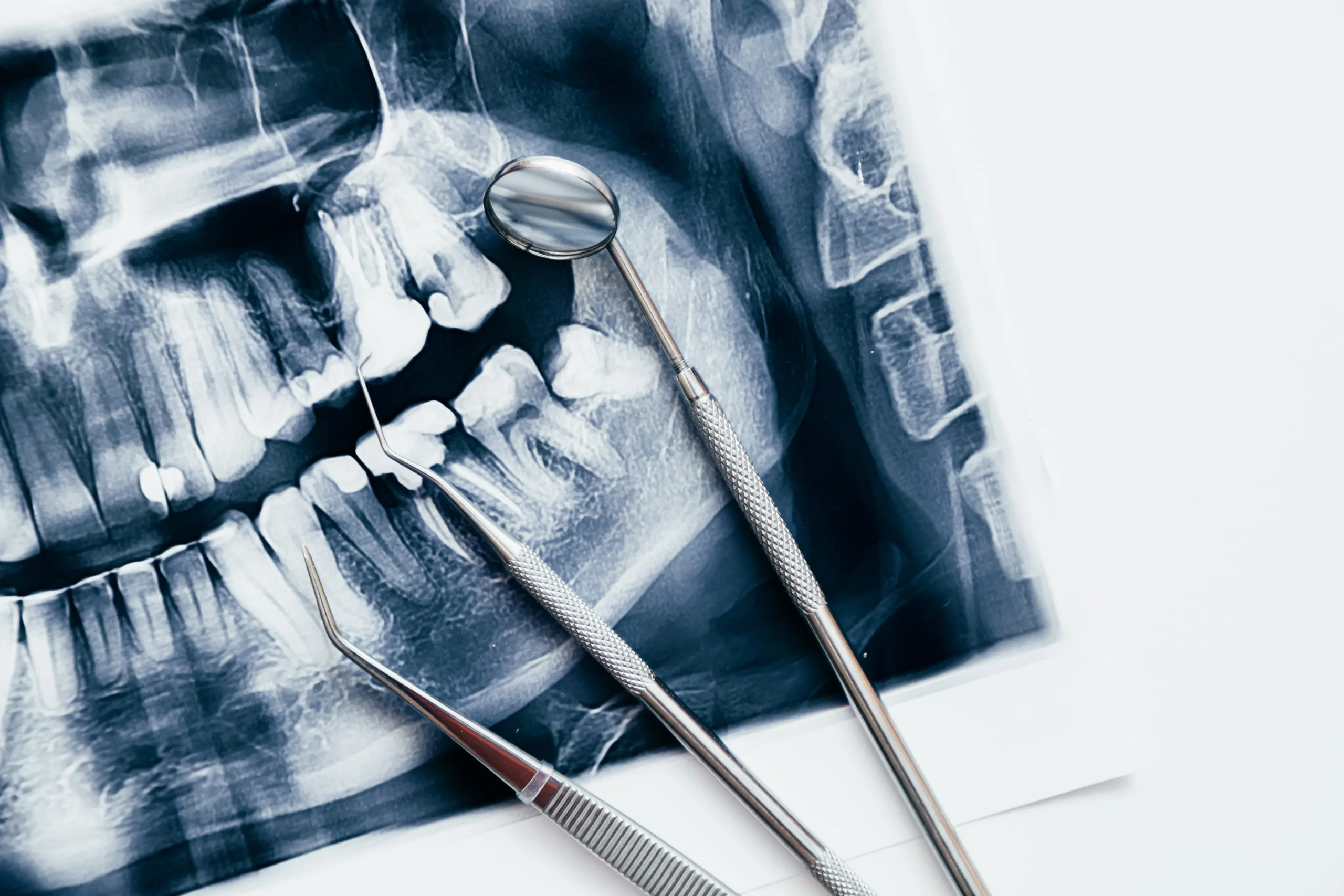 Espejo intraoral, sonda y pinzas clínicas colocados sobre una radiografía dental panorámica para el diagnóstico de tratamientos en la clínica Dentelier en Alicante.
