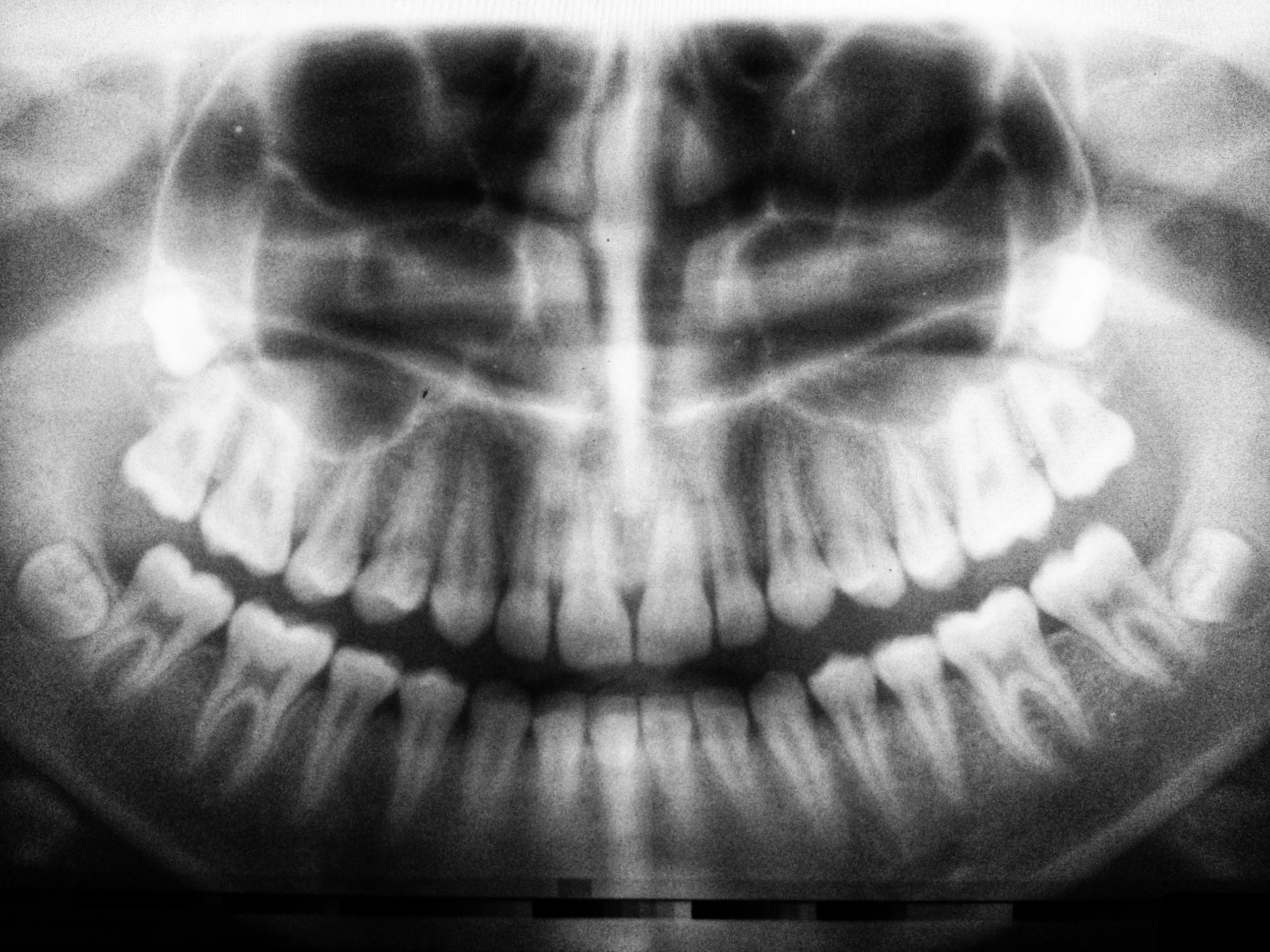 Radiografía panorámica dental en blanco y negro que muestra la estructura ósea completa, arcadas maxilares y piezas dentales para diagnóstico clínico en la clínica Dentelier en Alicante.